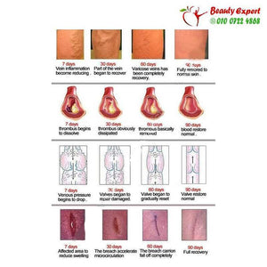 Varicose Veins Cream image 1