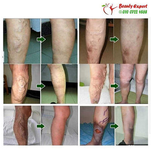 Varicose Veins Cream image 2